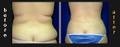 laser liposuction of the back galumbeck plastic surgery virginia beach