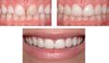 A combination of veneers and crowns.