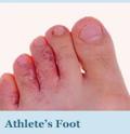 athletes-foot