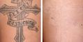 Tattoo Removal - Before & After Photos