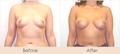 20a Breast Enlargement   Scarless Gallery