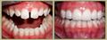 Case 5 Before and After Photos: Porcelain Veneers at Our North Carolina Center