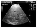 What is an Abdomen/Pelvic or Renal Sonogram?
