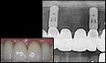 bridges-dental-implants