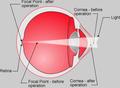 LASIK eye diagram