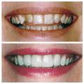 ADG-Aurora-Dentist-Smile-Makeover