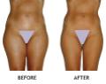 Endermologie Cellulite Treatment before & after photo