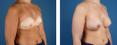 breast augmentation photos