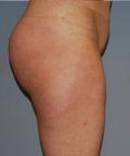 Body Contouring Case 121 - Liposuction - Before