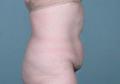 After Massive Weight Loss Case 257 - Tummy Tuck detroit