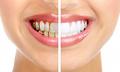 Cosmetic Dentistry Improves Appearance of a Patient's Smile.