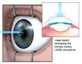 (Still frame of the animation; depicts laser beam reshaping the cornea during LASIK procedure. A textual description of the animation follows below.)