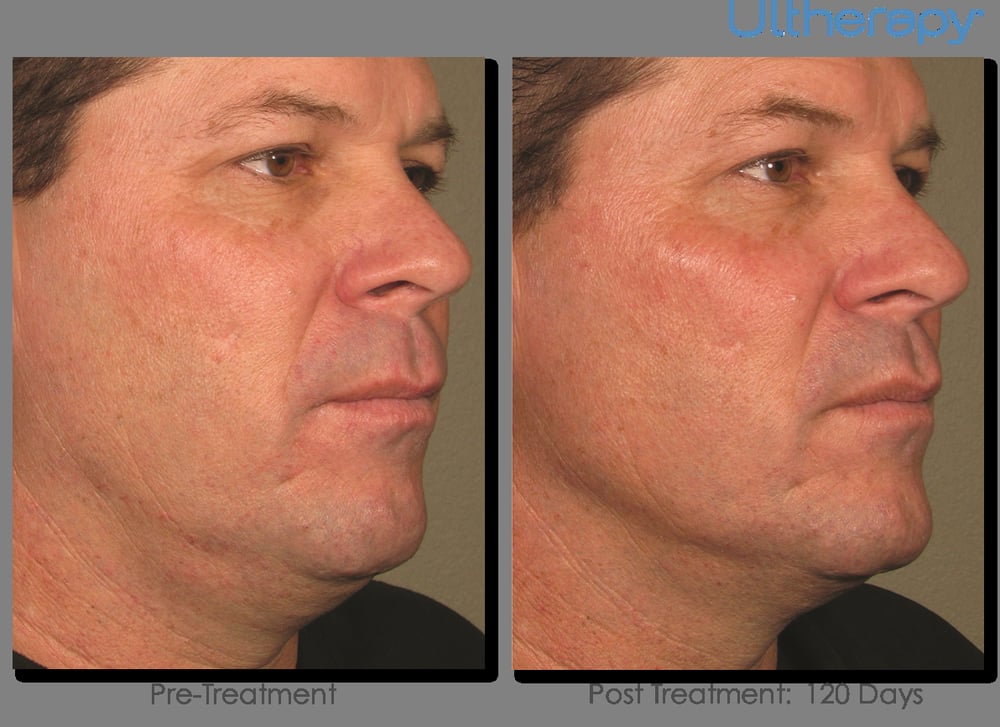 Ultherapy Lifts & Tightens