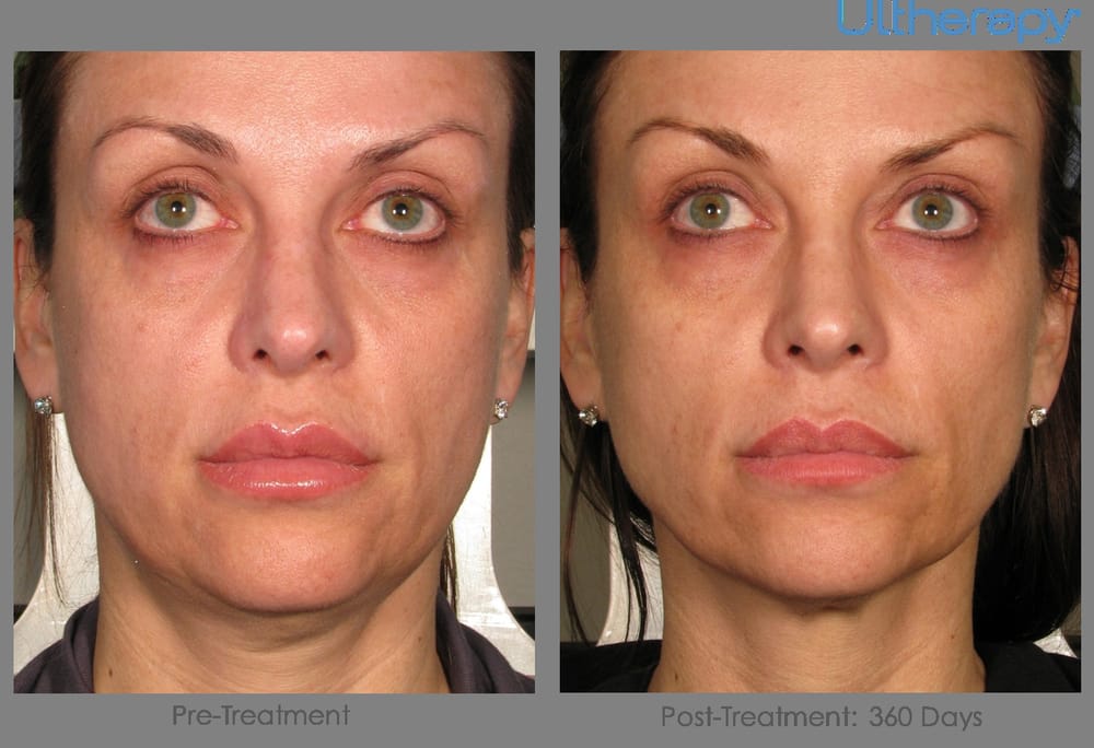 Ultherapy for Sagging Skin