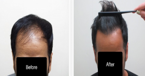 AZ Hair Restoration