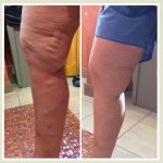 Leg Vein Before and after