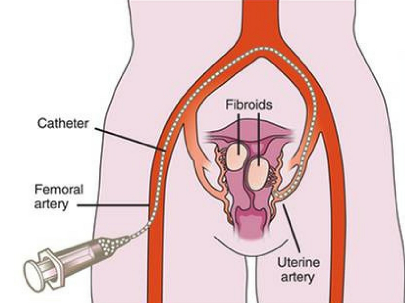 Uterine Fibroid Treatment