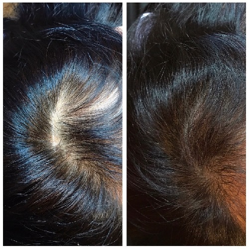 seattle scalp micropigmentation