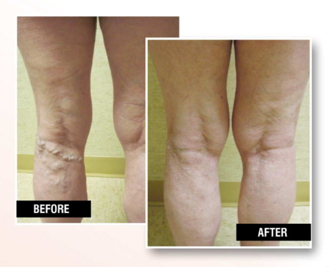 Before and After Vein Treatments